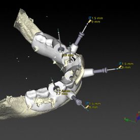 Clínica Dental J. Francisco Ramos López dentadura en 3D