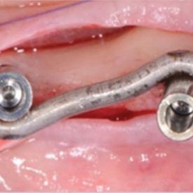 Clínica Dental J. Francisco Ramos López boca con prótesis 